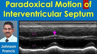 Paradoxical Motion of Interventricular Septum [upl. by Jonathon]