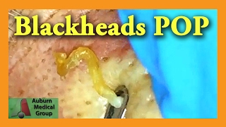 Blackheads POP  Auburn Medical Group [upl. by Yebot]