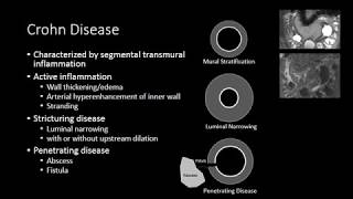 Small Bowel Inflammation [upl. by Unam108]