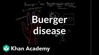 Buerger disease  Circulatory System and Disease  NCLEXRN  Khan Academy [upl. by Kramer]