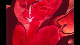 Mitraclip Transcatheter Mitral Valve Repair Procedure Animation [upl. by Bonni]