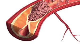 Atherosclerosis  Plaque Animation Model [upl. by Atekihs825]