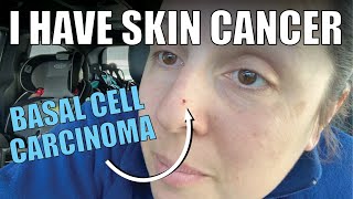 I HAVE SKIN CANCER  Basal Cell Carcinoma  signs what it looks like biopsy treatment plan [upl. by Nylirad]