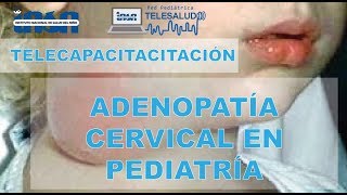 Adenopatía Cervical en Pediatría  Telecapacitación INSN [upl. by Akenor]