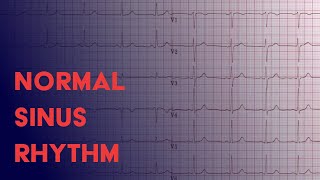 Normal Sinus Rhythm  EKG ECG Interpretation [upl. by Eatton]