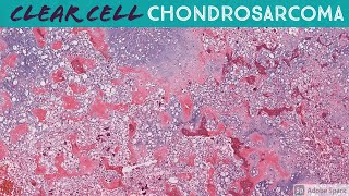 Clear Cell Chondrosarcoma [upl. by Idnat]