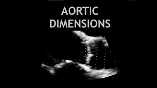 How to measure the AORTA Echocardiogram [upl. by Ycal]