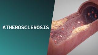 Atherosclerosis  Pathologies [upl. by Inirt26]