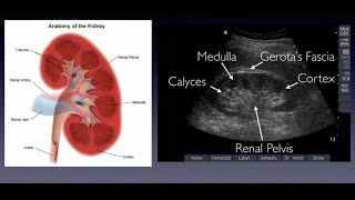 Introduction to Renal Ultrasound [upl. by Catha]