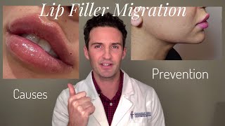 Lip Filler Migration Causes amp Prevention [upl. by Krista]