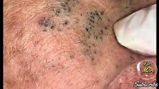 Dr Pop  Deep Blackheads in old Skin removing amp treatment 2020 Part 4 HD [upl. by Janos]