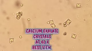 Calcium Oxalate crystals in urine routine microscopyCaOxlate 40X Acidic crystals in urine [upl. by Eglanteen168]