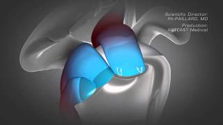 Shoulder Arthroscopy  Rotator Cuff Repair [upl. by Nomma]