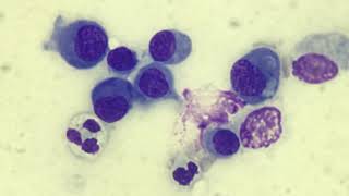 Mesothelial cells in effusion [upl. by Ramraj69]