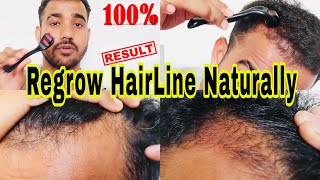 Regrow Hairline Naturally DERMA ROLLER for Hair Growth For Men amp Women  हिंदी में P SQUARE SALON [upl. by Gabriellia269]