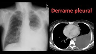 Derrame pleural [upl. by Eenert246]