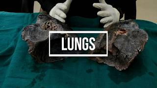 Lungs  gross anatomy [upl. by Ewan]