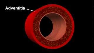 Atherosclerotic disease [upl. by Hayton]