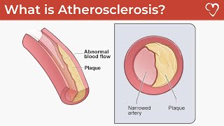 What is Atherosclerosis [upl. by Enelia]