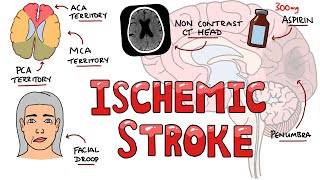 Imaging of Ischemic Stroke For Medical students residents and clinicians [upl. by Carn]