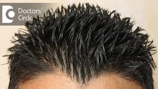 How to treat Androgenic Alopecia not responding to minoxidil amp finasteride  Dr Aruna Prasad [upl. by Amikan]