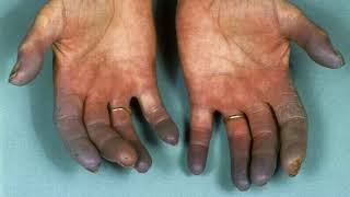 Difference Between Raynaud’s Disease and Buerger’s Disease [upl. by Nnylorac141]