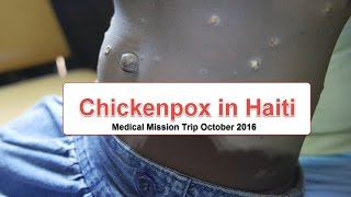 Chickenpox or Varicella in Haiti [upl. by Seidnac]