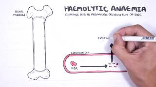 Haemolytic Anaemia  classification intravascular extravascular pathophysiology investigations [upl. by Paza489]