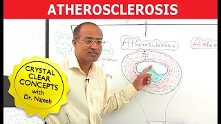 Atherosclerosis  Pathophysiology [upl. by Bone971]