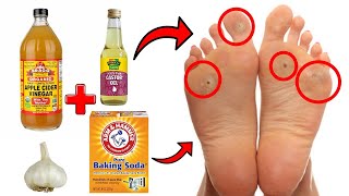 14 Proven Home Remedies For Corns amp Callus Removal THAT WORK [upl. by Yekcaj]