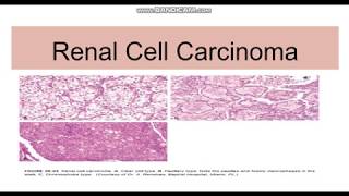 Renal cell carcinoma TypesGeneticsMorphology [upl. by Muiram]