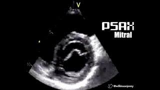 Parasternal Short Axis Mitral Level PSAX Mitral [upl. by Yelsnya]