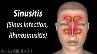 Sinusitis Animation [upl. by Nuahs]